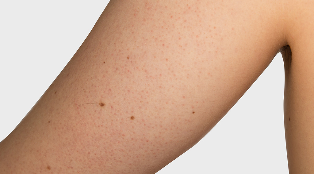Keratosis Pilaris Gold Bond Rough And Bumpy Your Bumpy Skin Might Be Keratosis Pilaris | Rough and Bumpy | CeraVe